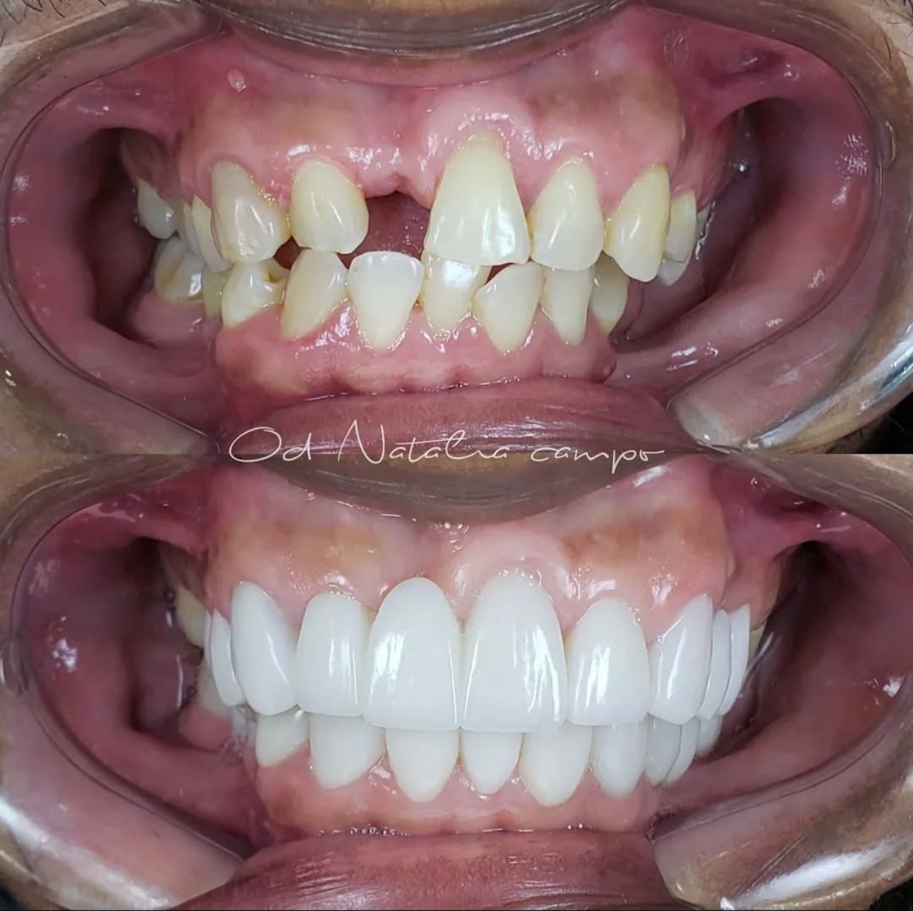 Coronas y Rehabilitación Oral