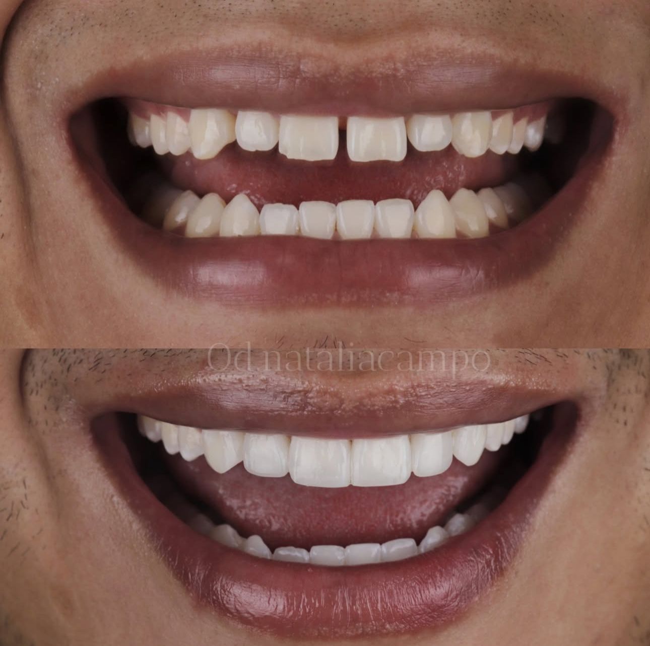 Mini Diseño de Sonrisa